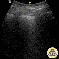 Pulmonary - Pleural Shred Sign