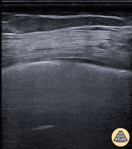 Pulmonary - COVID-19 Lung Findings