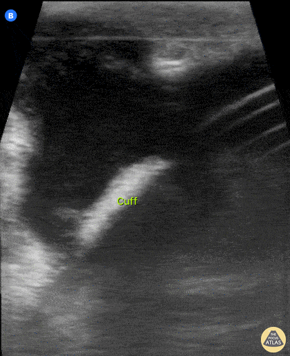 Bowel-GI - Peritoneal Catheter Complication