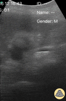 Biliary - Biliary Colic