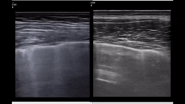 Pulmonary - B-lines in COVID-19 Versus CHF