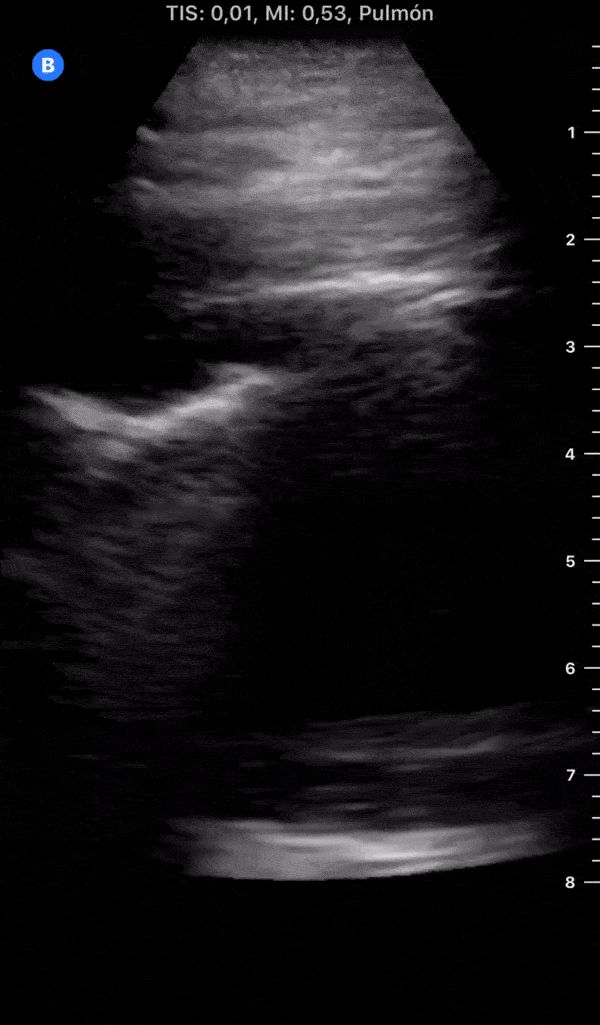 COVID 19 Lung US Disease Progression - Day 3