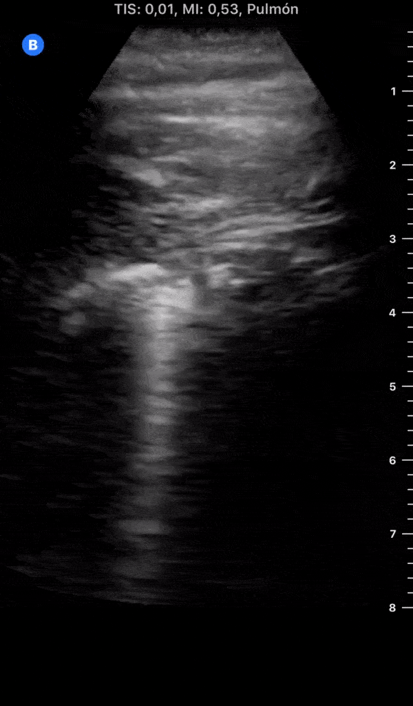 COVID 19 Lung US Disease Progression - Day 4