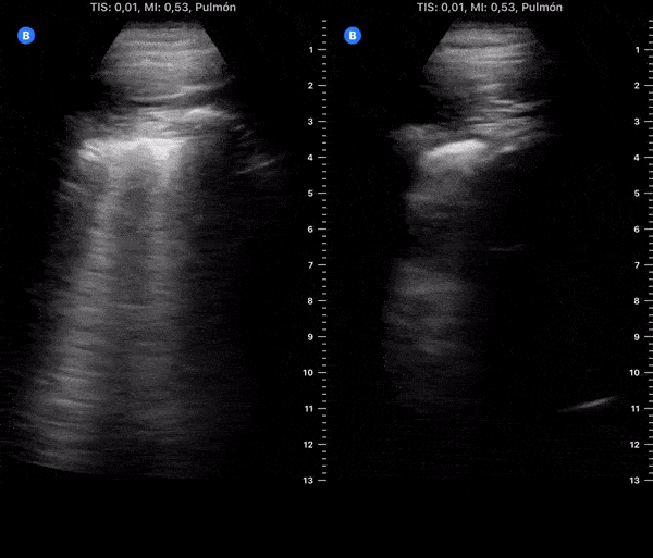 COVID 19 Lung US Disease Progression - Day 15