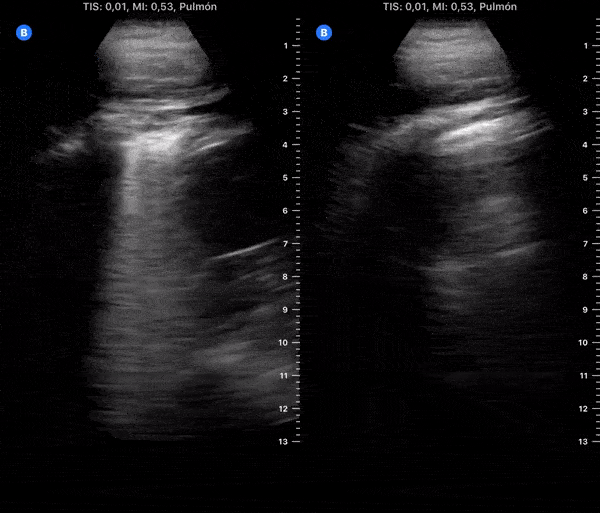 COVID 19 Lung US Disease Progression - Day 16