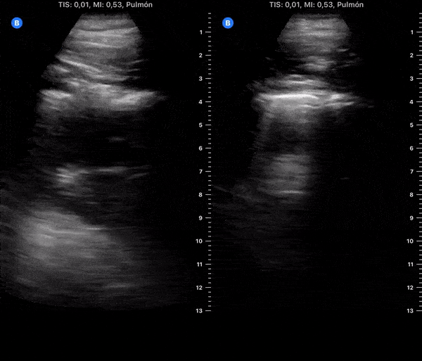 COVID 19 Lung US Disease Progression - Day 17