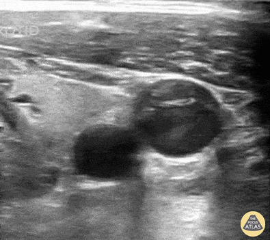 Vascular - Swirling Blood in the Internal Jugular Vein after Aortic Dissection