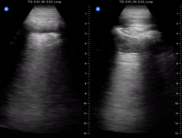 Pulmonary - Hospitalized COVID-19+ Patient on Day 9 of Symptoms [1/2]