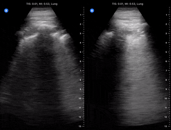 Pulmonary - Hospitalized COVID-19+ Patient on Day 9 of Symptoms [2/2]