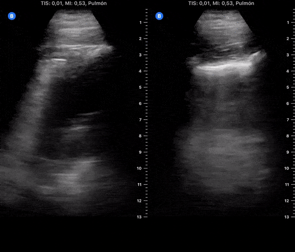 COVID 19 Lung US Disease Progression - Day 19