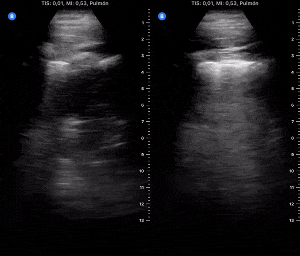 COVID 19 Lung US Disease Progression - Day 18