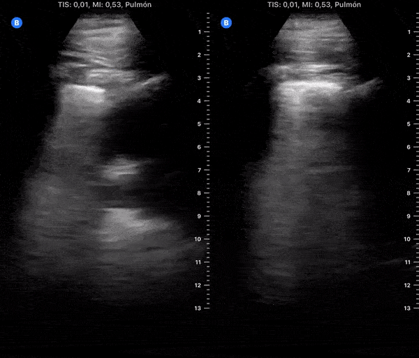 COVID 19 Lung US Disease Progression - Day 20