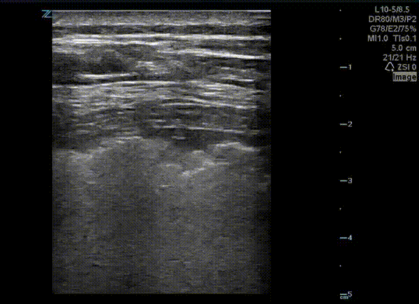 Pulmonary - Pleural Findings in COVID-19