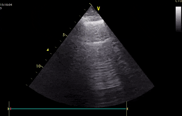 Pulmonary - A Hypoxic COVID-19 Patient