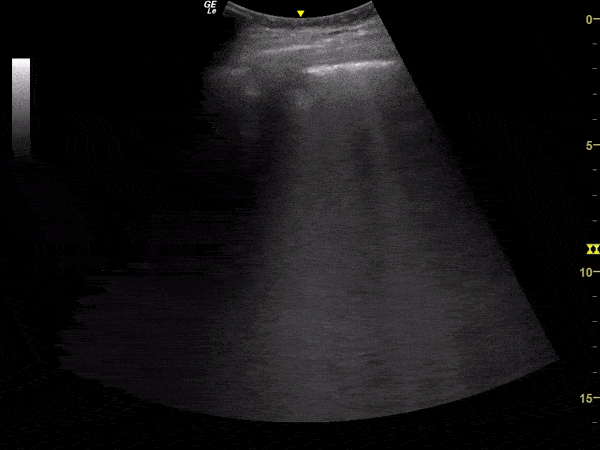 Pulmonary - Subpleural Consolidation in Suspected COVID-19 Pneumonia