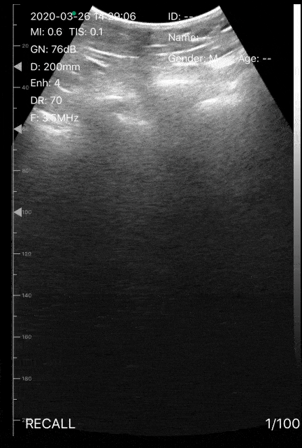 Pulmonary - A Young Man with Hypoxia and Cough