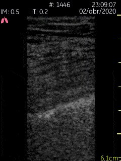 Pulmonary - Pleural Findings in COVID 19