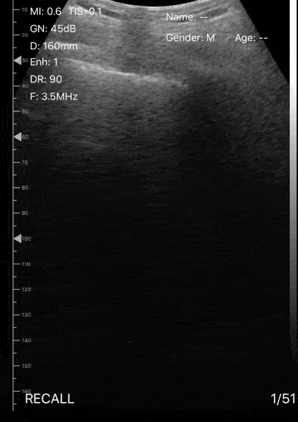 Pulmonary - Lung US Findings in Hypoxic Patient with Suspected COVID-19