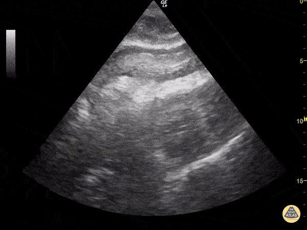 Pericardial Disease - Cardiac Tamponade in PEA