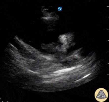 Right Ventricular Dysfunction - Hyperechoic lesion with enlarged RV from PE