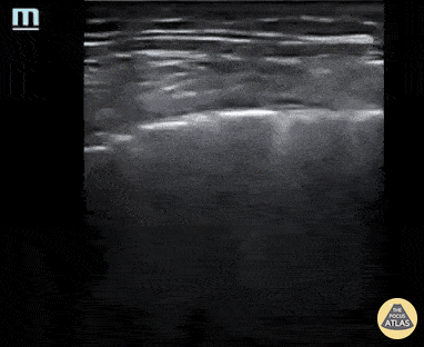 Pulmonary - COVID-19 pneumonitis