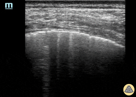 Pulmonary - Atypical presentation COVID-19