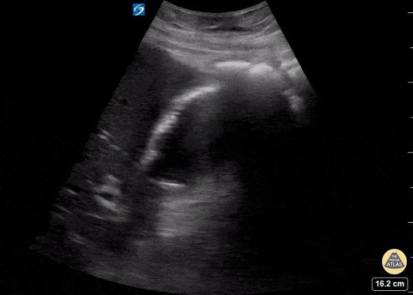 Biliary - Angry gallbladder