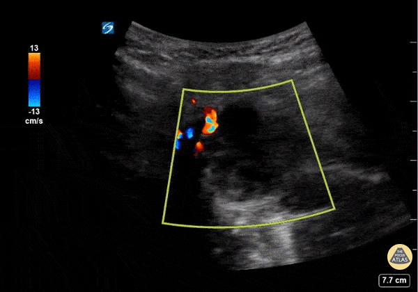 Soft Tissue - Submandibular Abscess