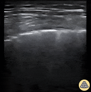 Pulmonary - COVID-19 Pneumonitis