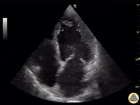 Left Ventricular Dysfunction - LV Thrombus