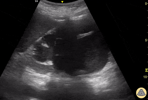 Renal/GU - Bear Paw Sign