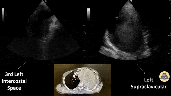 Aorta - Subacute Aortic Trauma