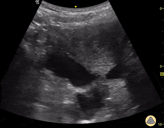 Trauma - Free Fluid within Abdomen
