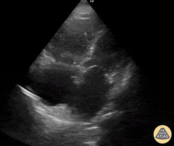 Right Ventricular Dysfunction - McConnell's Sign