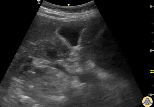 Renal/GU - Simple Renal Cyst