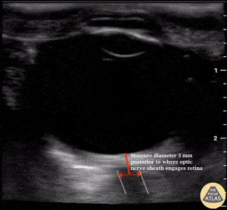Blog - A Neurointensivist’s Approach to POCUS for Increased ICP - Optic Nerve Sheath Dilation Occurs in Elevated ICP.