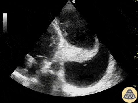 EA Echo Examples - Apical Four Chamber with Pleural Effusion