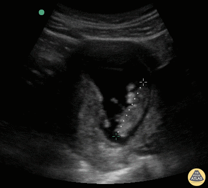 OB Dating Atlas - Week 10 - Crown Rump Length (CRL)