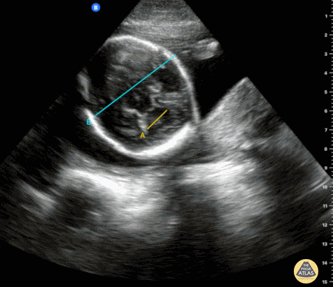 OB Dating Atlas - Week 22 - Biparietal Diameter (BPD)