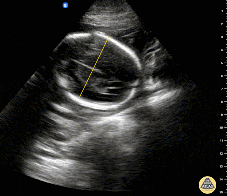 OB Dating Atlas - Week 15 - Biparietal Diameter (BPD)