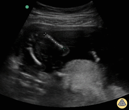 OB Dating Atlas - Week 17 - Femur Length