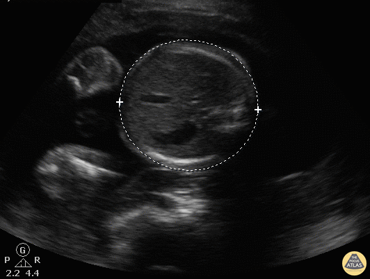 OB Dating Atlas - Week 25 - Abdominal Circumference (AC)