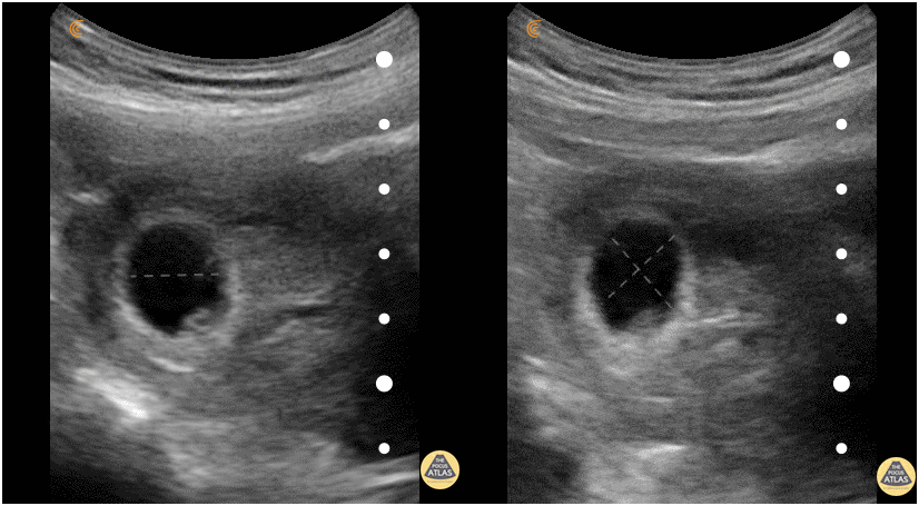 OB Dating Atlas - Week 4 - Mean Sac Diameter (MSD)