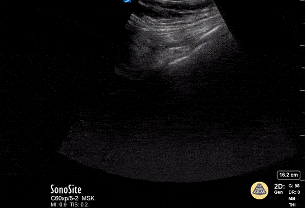 Pulmonary - The Light Beam Artifact in COVID-19