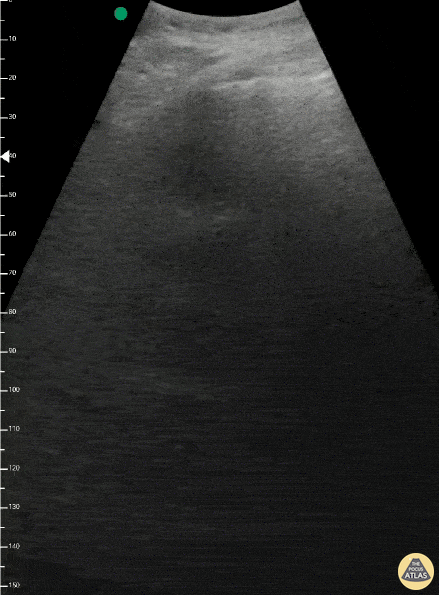 Pulmonary - Light Beam Sign (COVID-19)