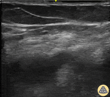 Vascular - Left femoral DVT