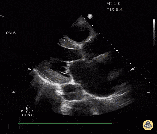 Thoracic Aortic Dissection & Aneurysm - Descending Thoracic Aortic Dissection Seen on PSLA