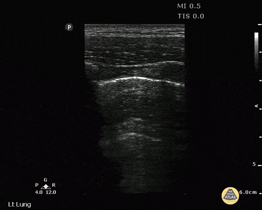 Pulmonary - Double Lung Point Seen in Pneumothorax