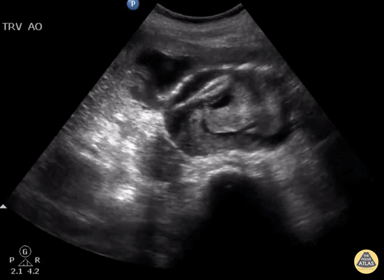 Aorta - Ruptured AAA with Active Hemorrhage