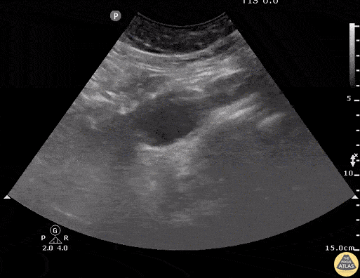 Aorta - Dissection Flap in Abdominal Aorta